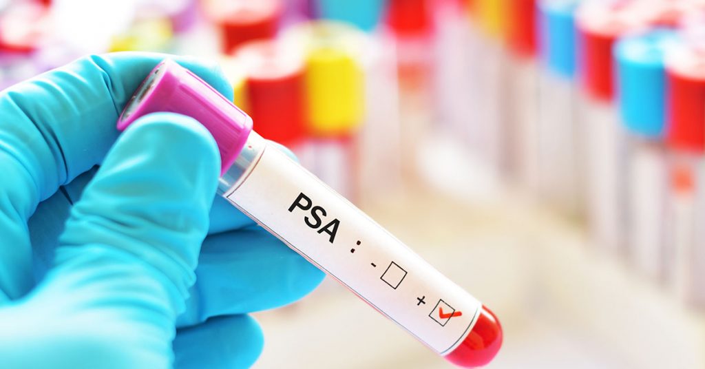 Blood sample positive with PSA, tumor marker for prostate cancer; blog: What are the Current Prostate Cancer Screening Guidelines?