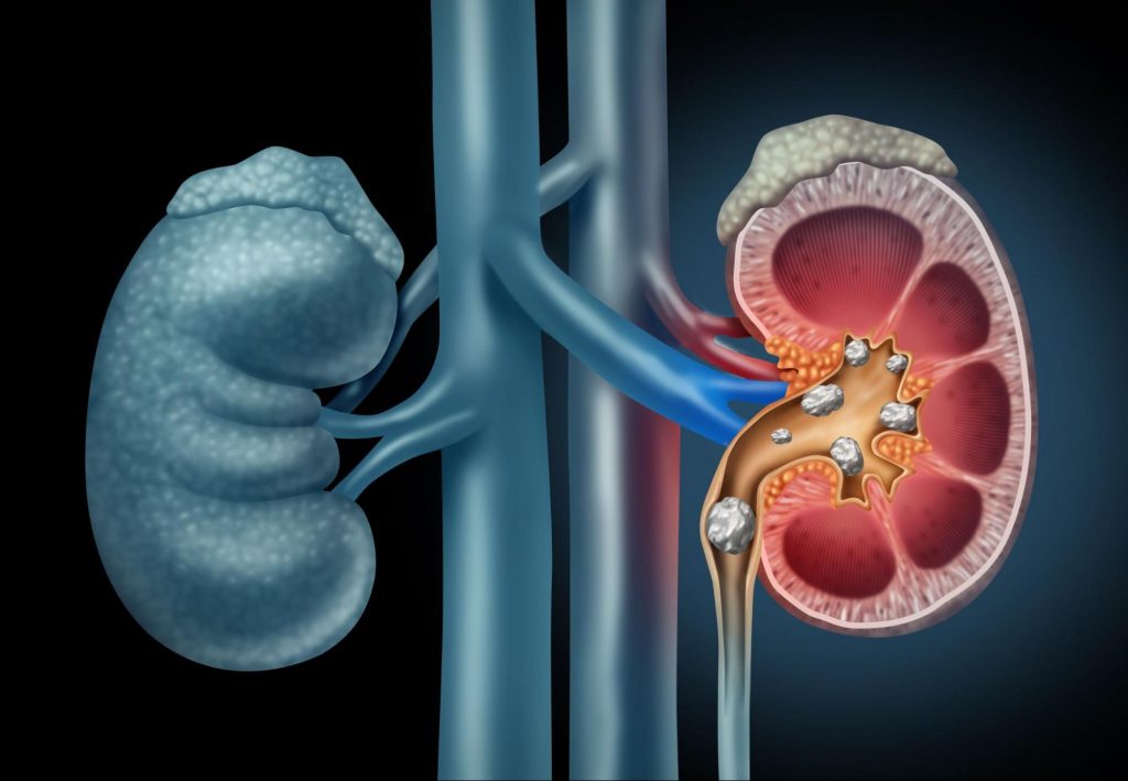 animation of kidney stones to signify how a urologist can help with kidney stones